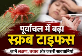scrub typhus, khabar kashi, varanai news, kashi news, today varanasi news, वाराणसी, वाराणसी समाचार, खबर काशी