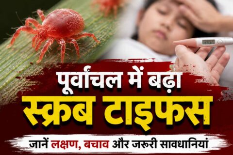 scrub typhus, khabar kashi, varanai news, kashi news, today varanasi news, वाराणसी, वाराणसी समाचार, खबर काशी