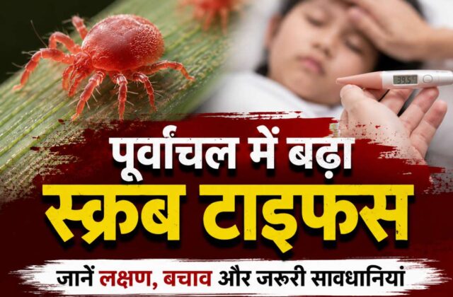 scrub typhus, khabar kashi, varanai news, kashi news, today varanasi news, वाराणसी, वाराणसी समाचार, खबर काशी