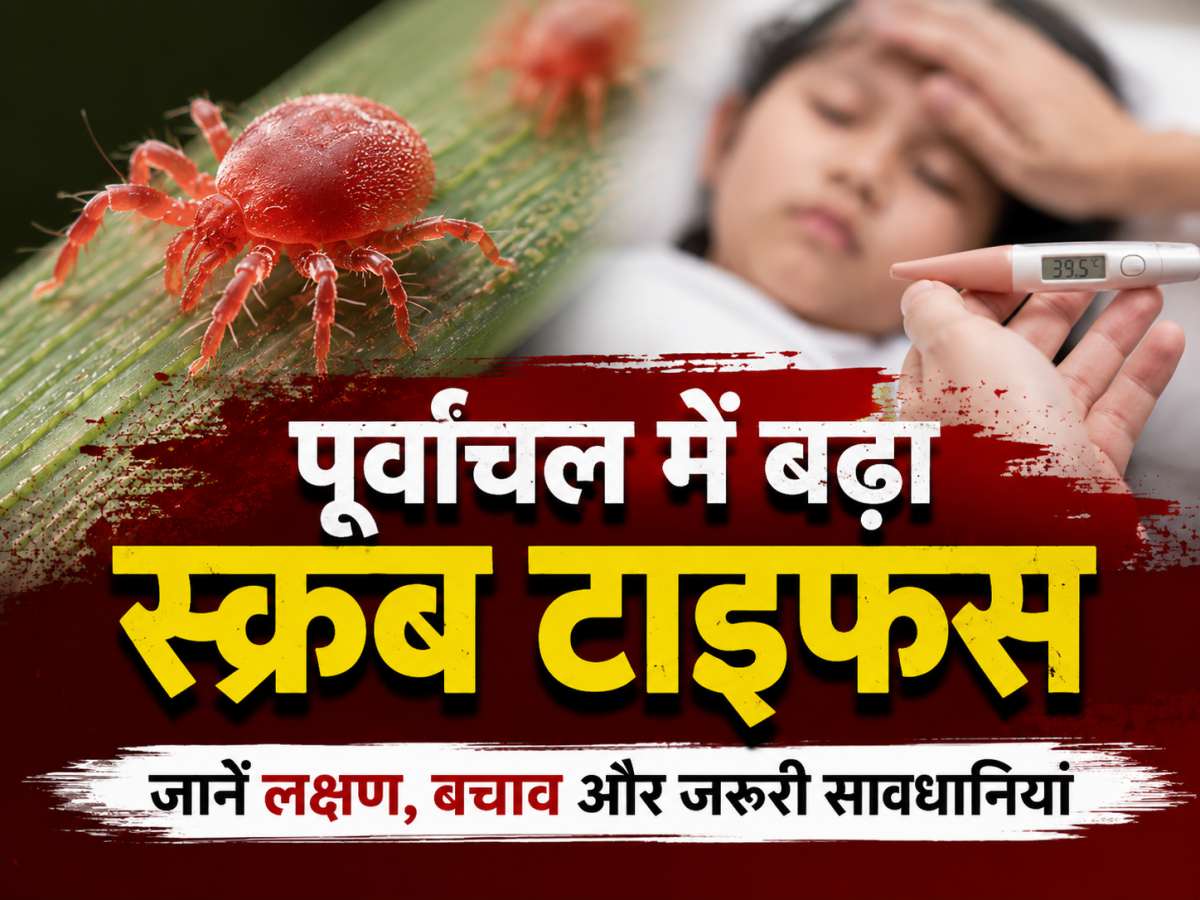 scrub typhus, khabar kashi, varanai news, kashi news, today varanasi news, वाराणसी, वाराणसी समाचार, खबर काशी