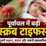 scrub typhus, khabar kashi, varanai news, kashi news, today varanasi news, वाराणसी, वाराणसी समाचार, खबर काशी